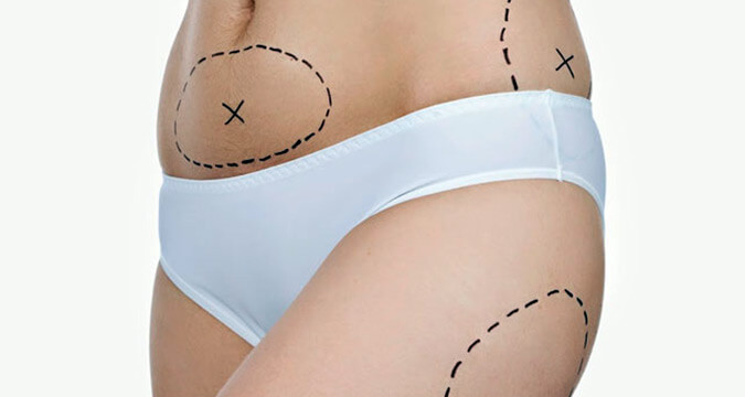 Adiposidad localizada, tejido adiposo que no desaparece con dieta o ejercicio.